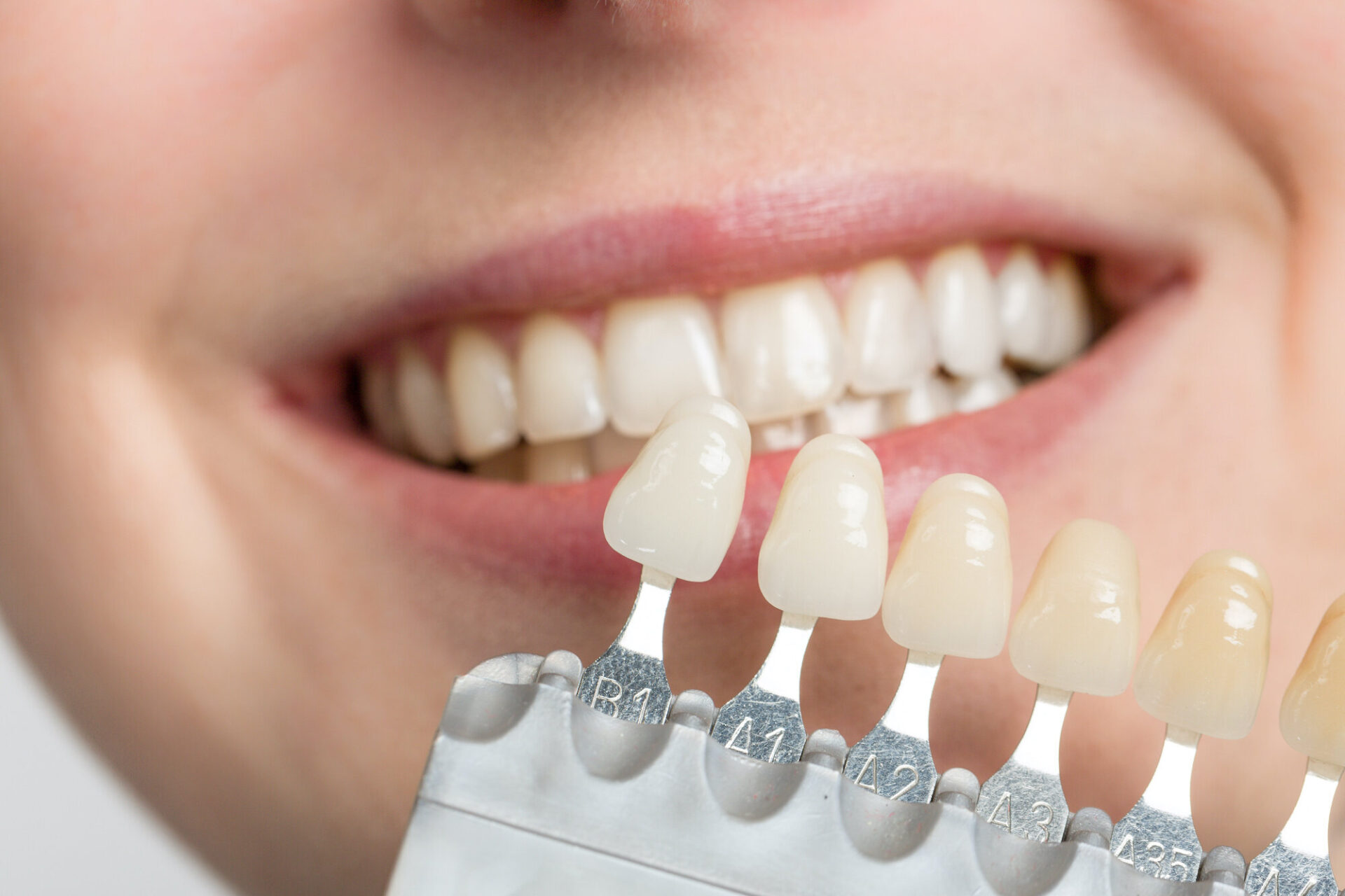 5 Signs that Show You Might Benefit from Veneers